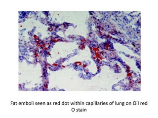 Fat emboli seen as red dot within capillaries of lung on Oil red
O stain
 