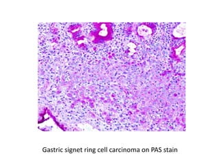 Gastric signet ring cell carcinoma on PAS stain
 