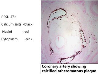 Coronary artery showing
calcified atheromatous plaque
RESULTS :
Calcium salts -black
Nuclei -red
Cytoplasm -pink
 