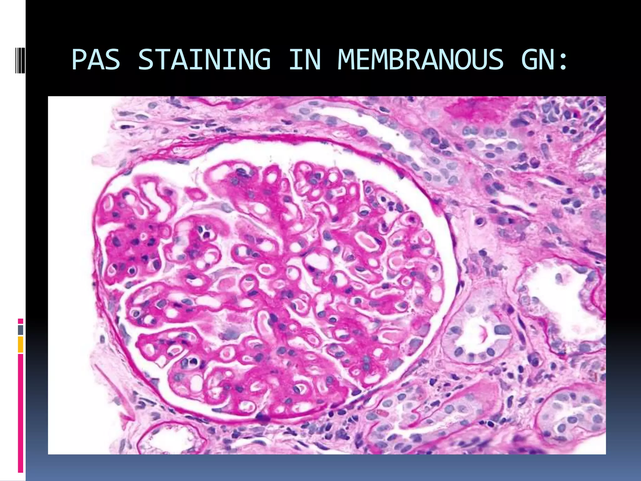 PAS STAINING IN MEMBRANOUS GN:
 