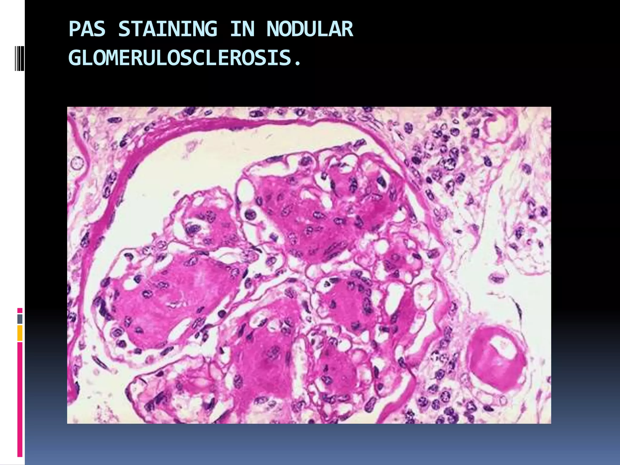PAS STAINING IN NODULAR
GLOMERULOSCLEROSIS.
 