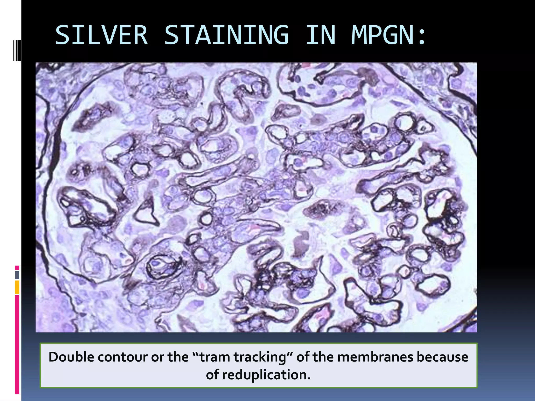 SILVER STAINING IN MPGN:
Double contour or the “tram tracking” of the membranes because
of reduplication.
 