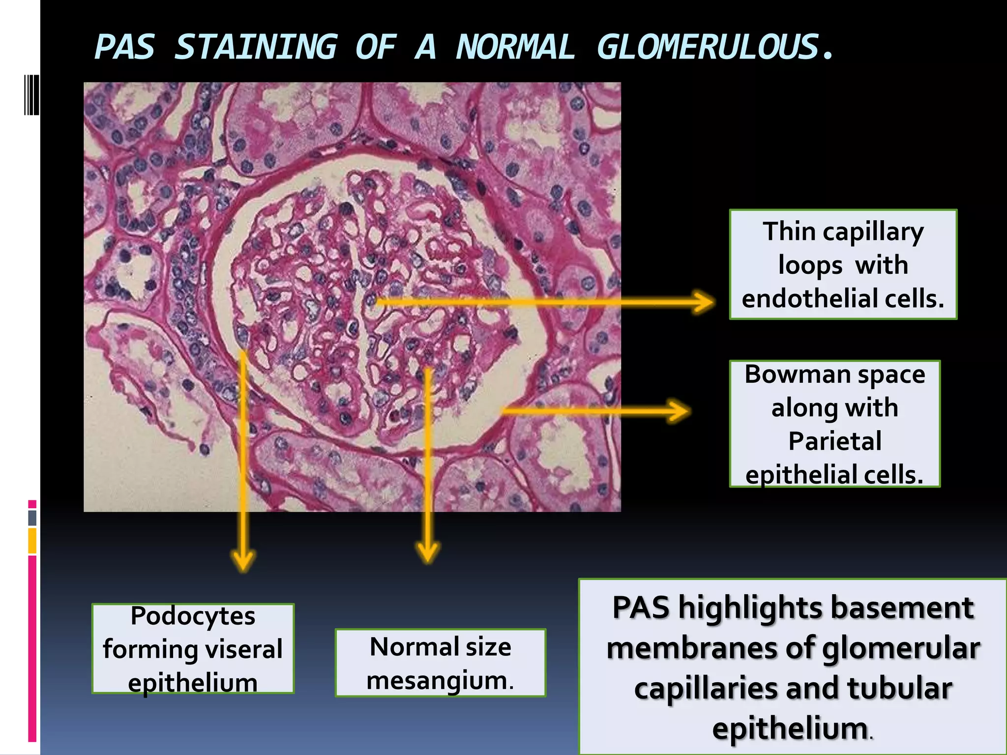 PAS STAINING OF A NORMAL GLOMERULOUS.
PAS highlights basement
membranes of glomerular
capillaries and tubular
epithelium.
Thin capillary
loops with
endothelial cells.
Normal size
mesangium.
Podocytes
forming viseral
epithelium
Bowman space
along with
Parietal
epithelial cells.
 