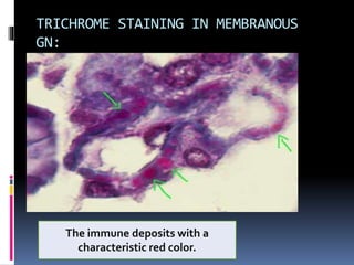 TRICHROME STAINING IN MEMBRANOUS
GN:
The immune deposits with a
characteristic red color.
 