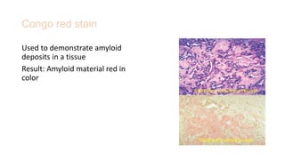 Congo red stain
Used to demonstrate amyloid
deposits in a tissue
Result: Amyloid material red in
color
Positive for amyloid stain
Medullary carcinoma thyroid
 