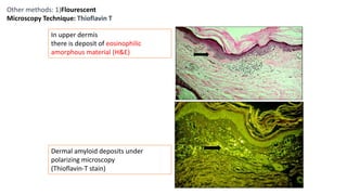 In upper dermis
there is deposit of eosinophilic
amorphous material (H&E)
Dermal amyloid deposits under
polarizing microscopy
(Thioflavin-T stain)
Other methods: 1)Flourescent
Microscopy Technique: Thioflavin T
 