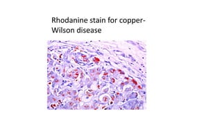 Rhodanine stain for copper-
Wilson disease
 