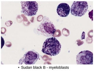 ● Sudan black B - myeloblasts
 