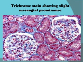 Trichrome stain showing slight
mesangial prominance
 
