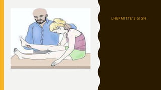 L H E R M I T T E ’ S S I G N
 