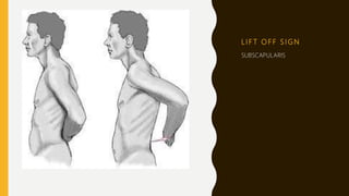 L I F T O F F S I G N
SUBSCAPULARIS
 