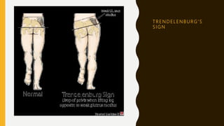 T R E N D E L E N B U R G ’ S
S I G N
 