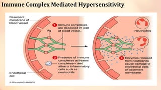 Immune Complex Mediated Hypersensitivity
 