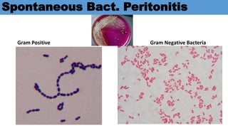Spontaneous Bact. Peritonitis
Gram Positive Gram Negative Bacteria
 