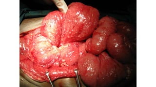 Specific causes of peritonitis