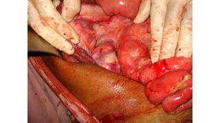 Specific causes of peritonitis