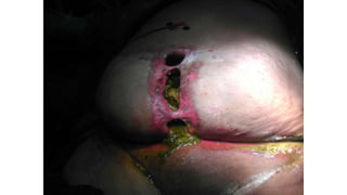 Specific causes of peritonitis