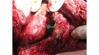 Specific causes of peritonitis