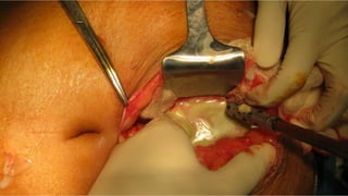 Specific causes of peritonitis