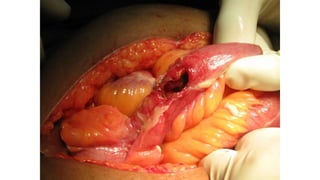 Specific causes of peritonitis