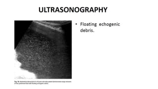 Specific causes of peritonitis