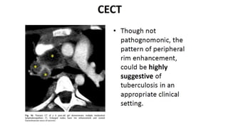 Specific causes of peritonitis