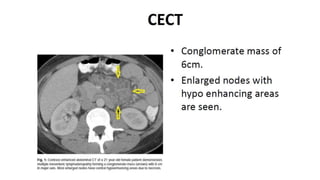 Specific causes of peritonitis
