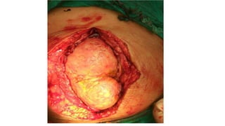 Specific causes of peritonitis