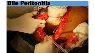 Bile Peritonitis
 