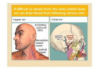 If difficult to obtain from the anteIf difficult to obtain from the ante--cubitalcubital fossafossa
we can draw blood from following various site:we can draw blood from following various site:
4. Jugular vein 5. Scalp vein
 