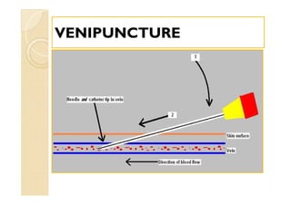 VENIPUNCTUREVENIPUNCTURE
 
