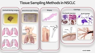 TissueSamplingMethodsinNSCLC
Excised during surgery Bronchoscopic biopsy Biopsy Cytology
Fine Needle Aspiration
ID-KEY-00090
Brush Cytology
 