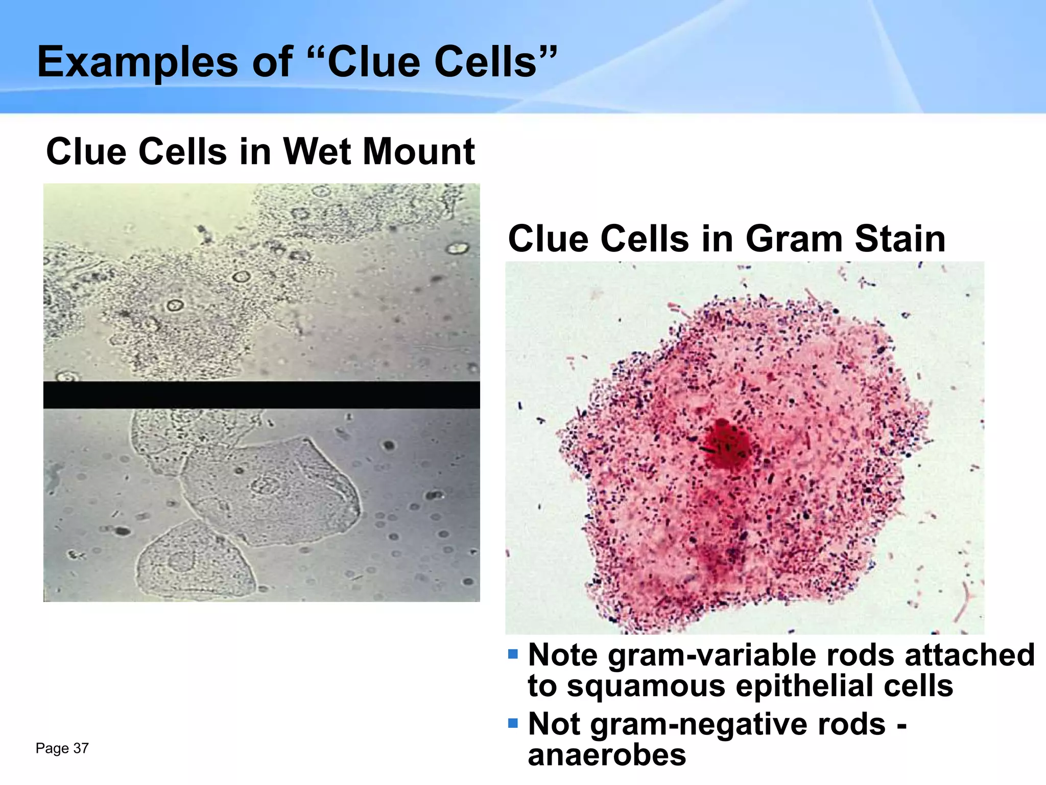 Page 37
Examples of “Clue Cells”
Clue Cells in Wet Mount
Clue Cells in Gram Stain
 Note gram-variable rods attached
to squamous epithelial cells
 Not gram-negative rods -
anaerobes
 