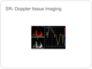 SR- Doppler tissue imaging
 