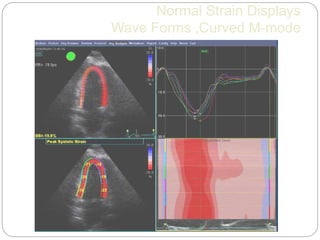 Normal Strain Displays
Wave Forms ,Curved M-mode
 