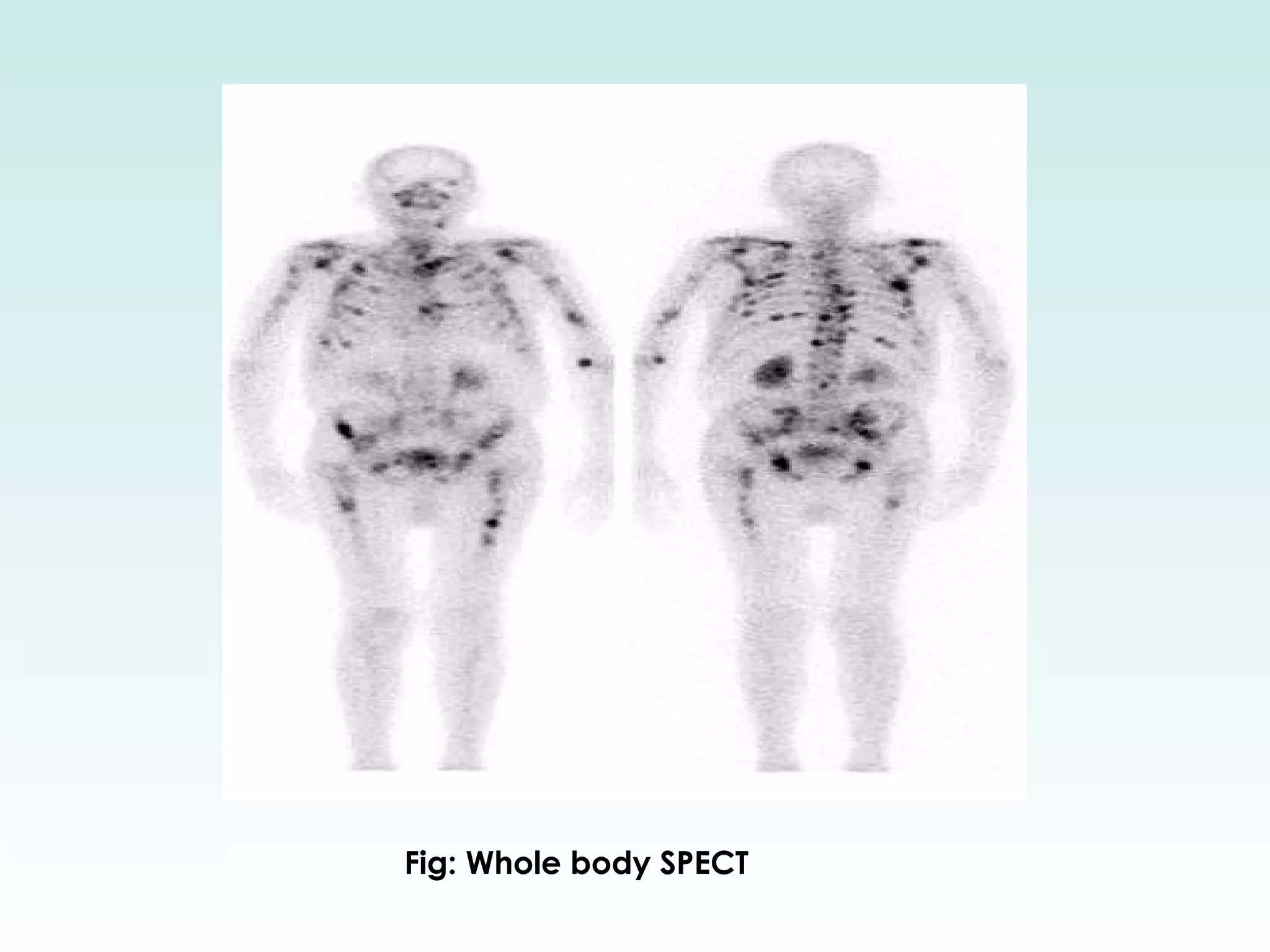 SPECT: Single Photon Emission Computed Tomography | PPT
