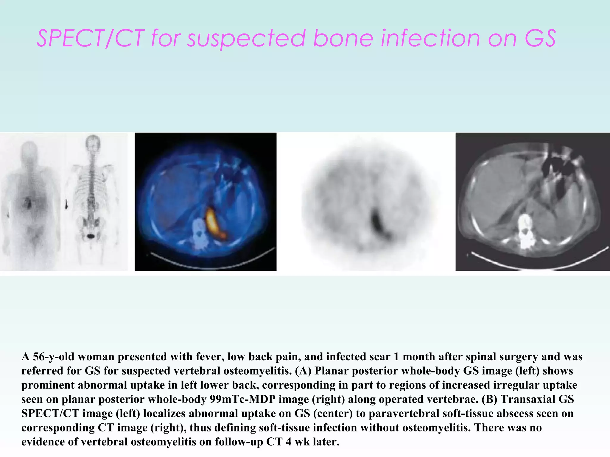 SPECT: Single Photon Emission Computed Tomography | PPT