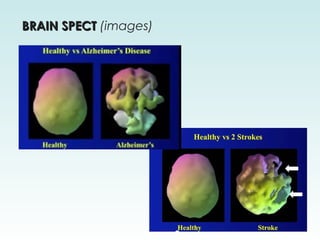SPECT: Single Photon Emission Computed Tomography | PPT