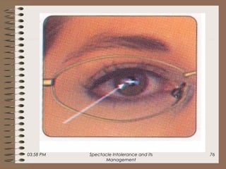 03:58 PM Spectacle Intolerance and its
Management
76
 
