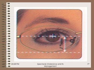03:58 PM Spectacle Intolerance and its
Management
77
 