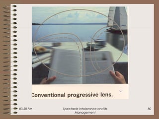 03:58 PM Spectacle Intolerance and its
Management
80
 