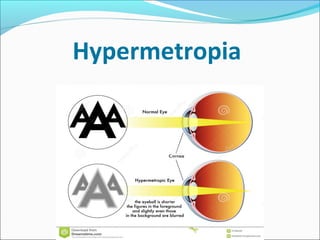 Spectacle prescription | PPT