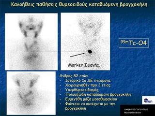 Καιμήζεηξ παζήζεηξ ζονεμεηδμύξ θαηαδοόμεκε βνμγπμθήιε




                                               99mTc-O4




                      Marker ΢θαγήξ.

                  Άκδναξ 82 εηώκ
                  - Ιζημνηθό Ca ΔΓ πκεύμμκα.
                  - Υεηνμονγεζέκ πνμ 3 εηίαξ
                  - Τπενζονεμεηδηζμόξ
                  - Πμιομδώδε θαηαδοόμεκε βνμγπμθήιε
                  - Γομεγέζε μάδα μεζμζςναθίμο
                  - Φαίκεηαη κα ζοκέπεηαη με ηεκ
                     βνμγπμθήιε
 