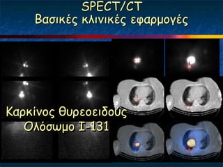 SPECT/CT
    Βαζηθέξ θιηκηθέξ εθανμμγέξ




Κανθίκμξ ζονεμεηδμύξ
   Οιόζςμμ Ι-131
 