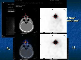 “Hot Nose”
     “The clown’s nose”




RL              LL
 