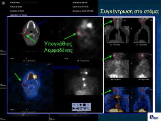 ΢ογθέκηνςζε ζημ ζηόμα;




Τπμγκάζημξ
Λεμθαδέκαξ


  ΢ΦΡΑΓΙ΢ΜΑΣΑ
 