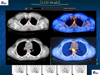 I-123 10 mCi




               SPECT
               coronal
 