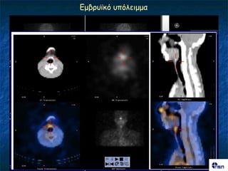 Γμβνοσθό οπόιεημμα
 