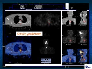 Θσρεοεηδηθό σπόιεηκκα;
  Θσρεοεηδηθό σπόιεηκκα



Τπερθιείδηος ιεκθαδέλας


Οζηηθή κεηάζηαζε κεηάζηαζε
    Λεκθαδεληθή
 