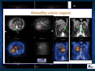 Καιοήζες θύζηε λεθρού
 